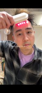 40代 頭皮ケア LLLT 頭皮の巡りをサポートする施術例 